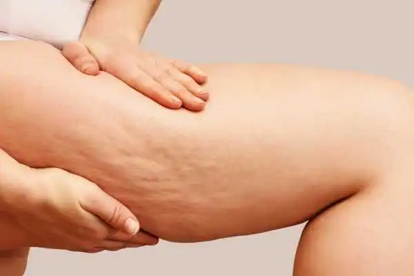 Image of woman showing leg with cellulite Southam