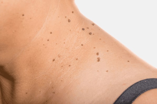 Are you looking for easy skin tag removal Southam - then contact Spire today!