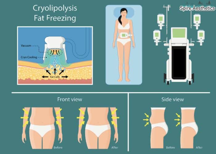 Image of diet and fat freezing combined for best results for Spire Aesthetics Southam
