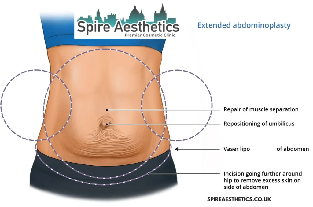 Understanding Loose Skin After Gastric Band Southam Surgery and HIFU Treatment