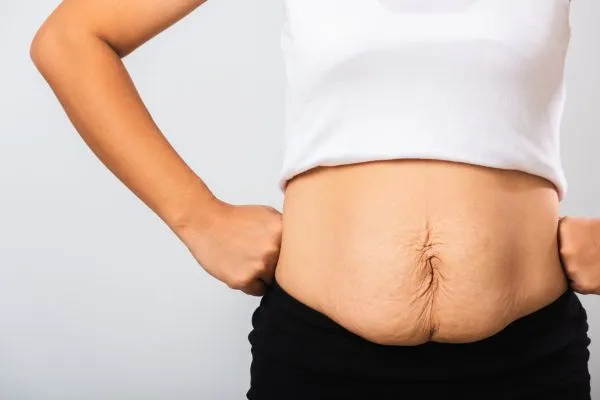 Image of a woman's stomach after weight loss with sagging skin following a gastric band Southam