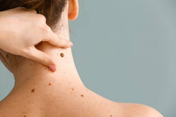 skin blemish removal Southam treatment