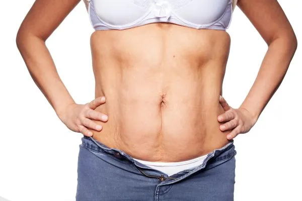sagging skin on woman's stomach after weight loss injections Southam