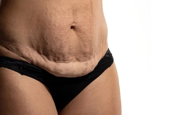 Image of womans stomach after weight loss injections Southam showing saggy skin