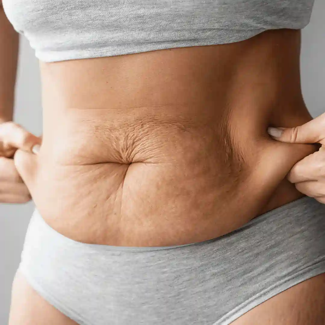 Is It Normal to Have Loose Skin After Pregnancy Southam?