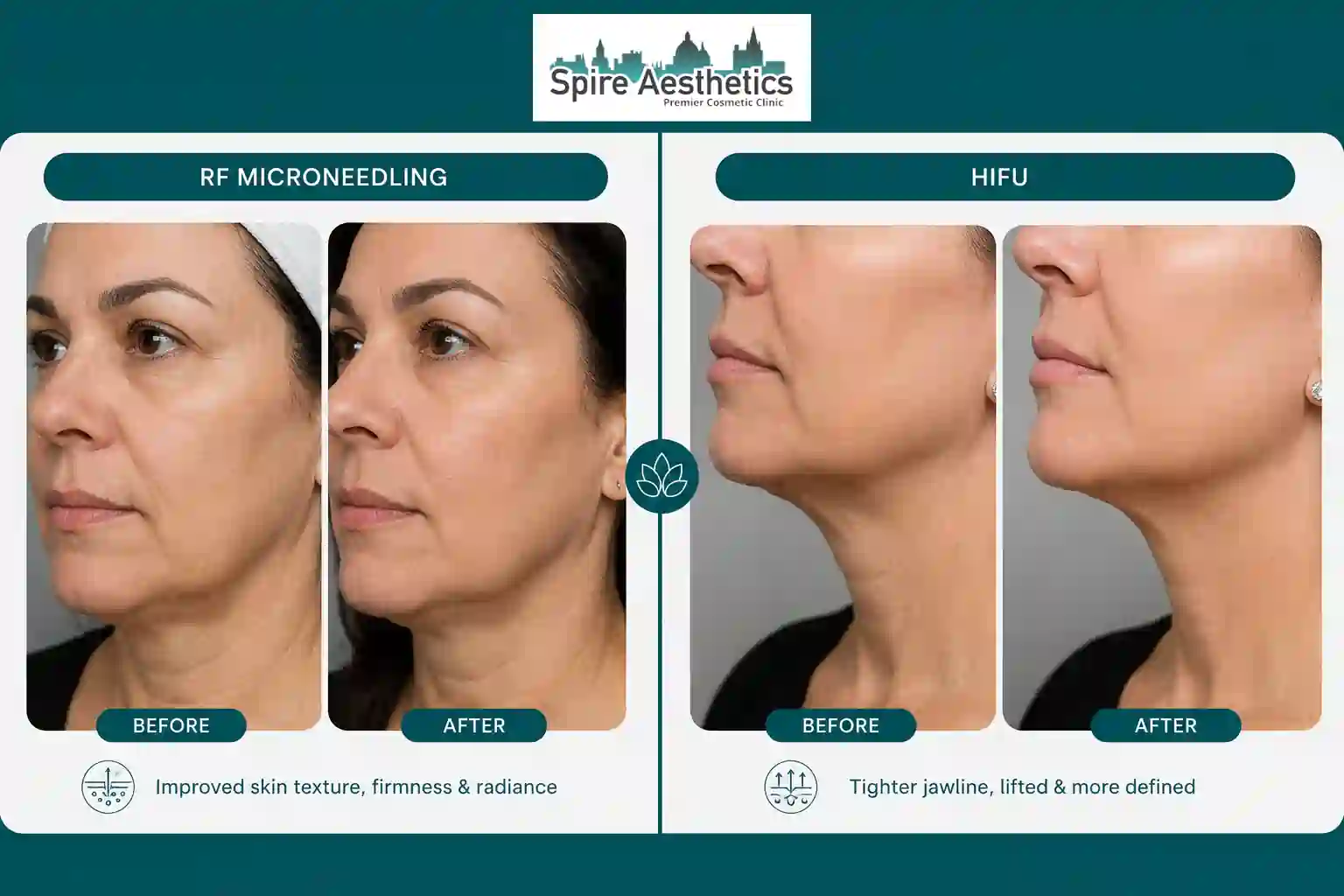 Can RF Microneedling and HIFU Be Combined Southam?