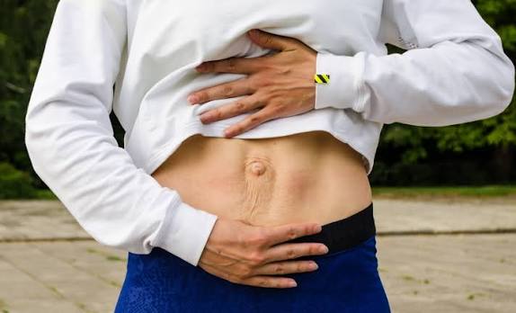 When Could Diastasis Recti Be the Missing Piece of the Puzzle Southam?