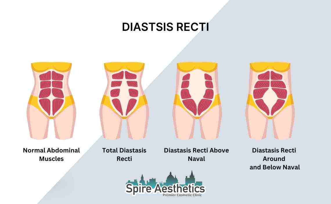 Is Non-Surgical Diastasis Recti Treatment Right for You? Common Concerns Answered Southam